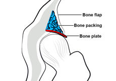 Acetabular Labrum Repair or Reconstruction