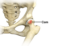 Femoral Cam Deformity