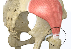 Gluteal Tendon Repair