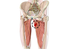 Core Muscle Injury: Chronic Hip Adductor/Groin Pain