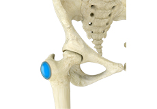 Hip Bursitis