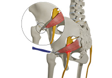 Piriformis Tendon Release