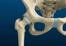 Stress Fractures of the Hip